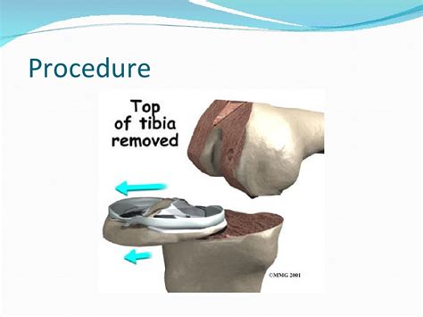 total knee replacement slideshare|Total knee replacement (tkr) ppt .